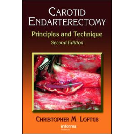 Carotid Endarterectomy